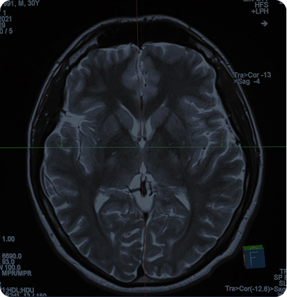 Neurological signal characterization